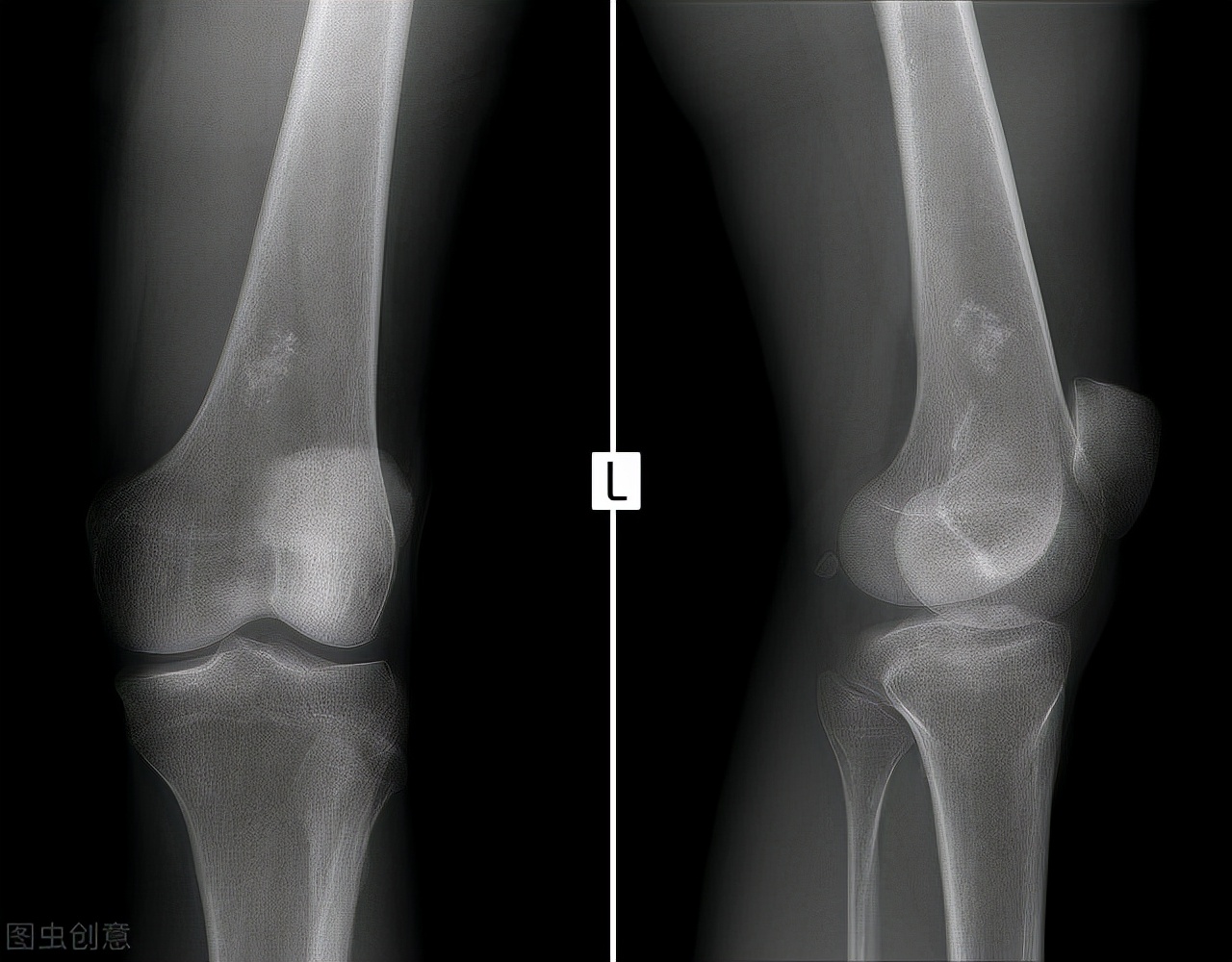 腰酸、腰痛一定是肾脏有问题吗