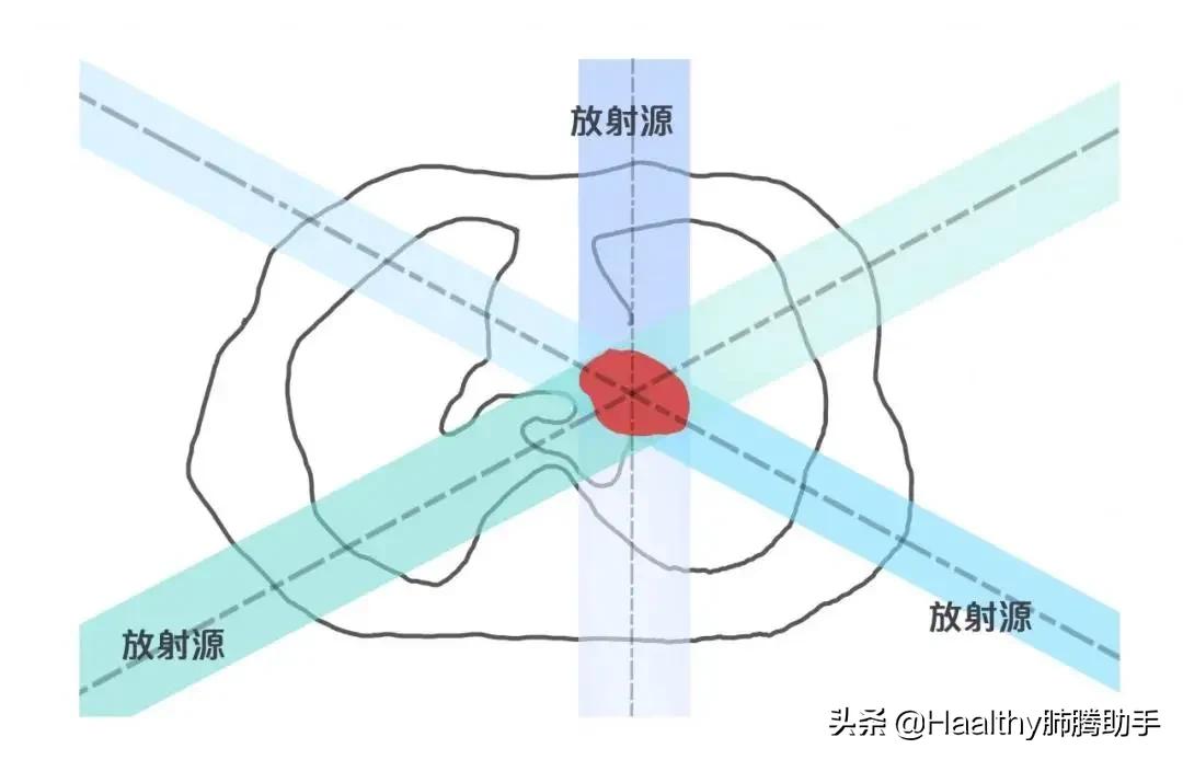 带着射线逛街，很拉风吧|肺腾讲堂：内放疗与外放疗的区别