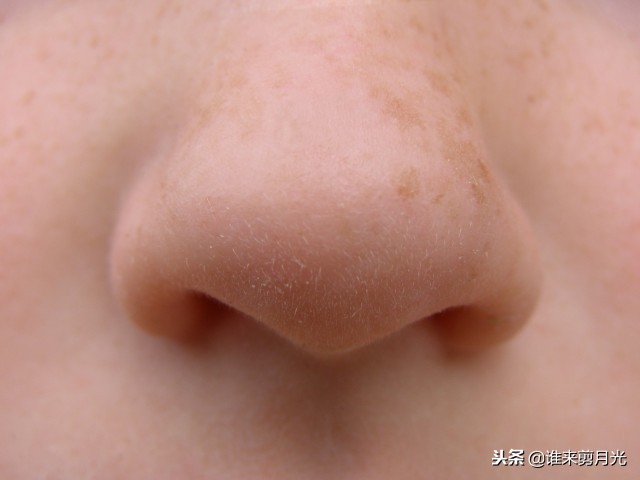 鼻子长痘有痘印快速消除方法,鼻子长痘快速消除方法儿童
