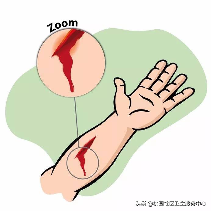 一厘米长的伤口要打碎伤风吗,小孩碰个小伤口打碎伤风吗