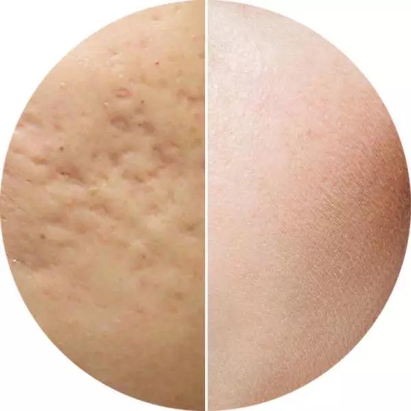 看懂各种痘痘类型和应对方法,一分钟教你分辨痘痘类型