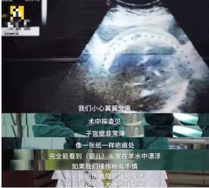 郑嘉颖老婆两年剖两胎？这样很危险