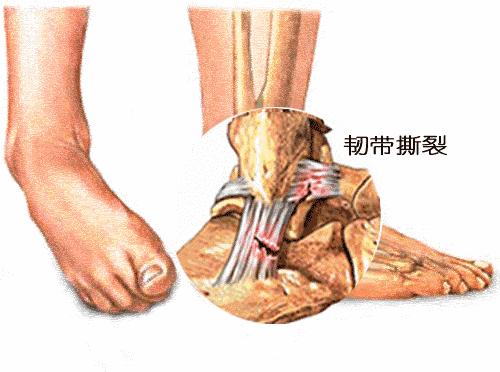 习惯性崴脚怎么锻炼脚踝力量,脚踝习惯性崴脚怎么恢复