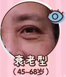 去眼袋15年后有细纹怎么办,祛眼袋之后会不会看着很平
