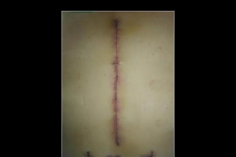 手术后一个月还有线头正常吗,手术后四个月刀口疼正常吗