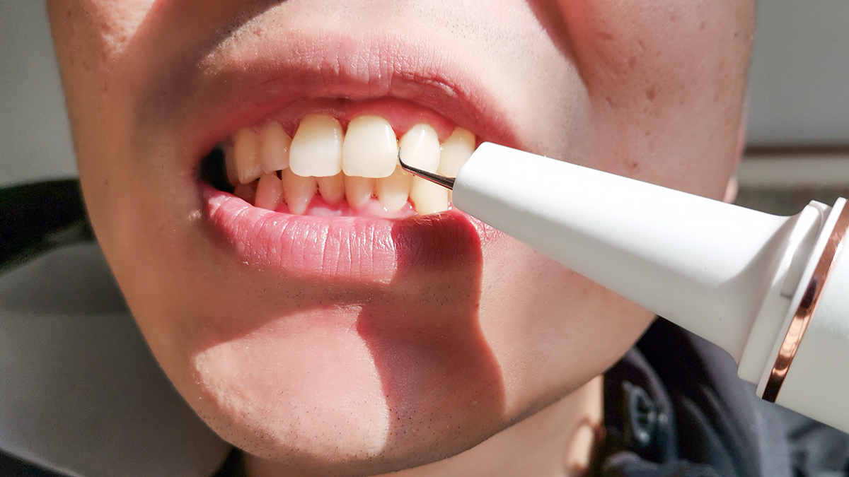 去除牙垢牙刷测评,洁牙神器和普通牙刷哪个好