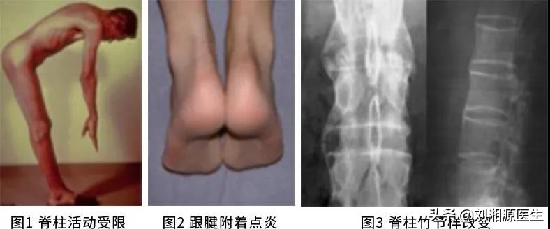 怀孕如何避免强直性脊柱炎,免疫修复治强直性脊柱炎