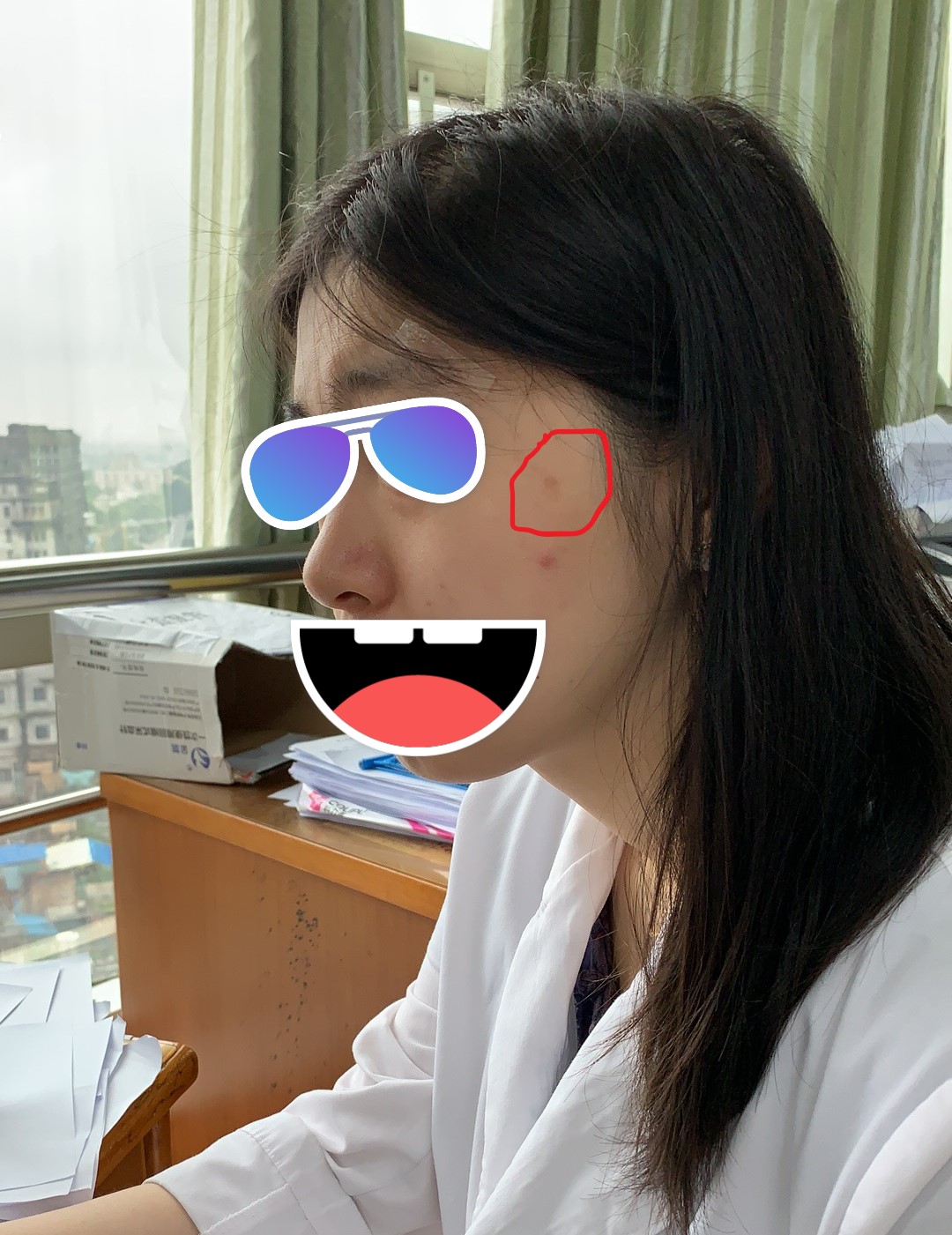 褐斑雀斑老年斑,老年斑褐斑晒斑图片