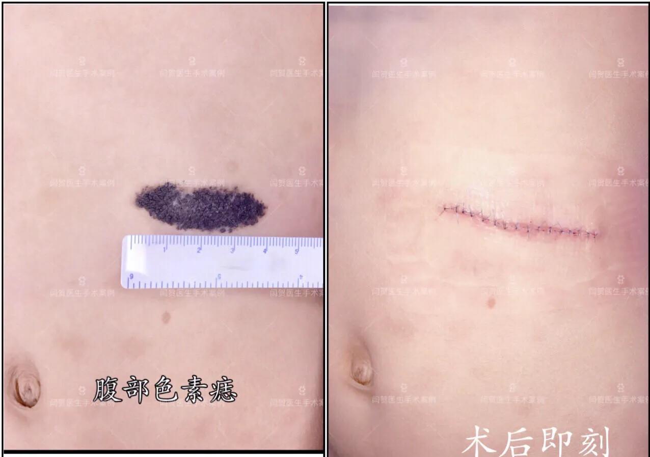 脚底有痣激光还是手术切除,黑色素痣手术切除还是激光去除好