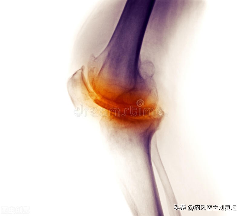 痛风发作大脚趾不能活动,痛风发作时只痛不肿不热为什么