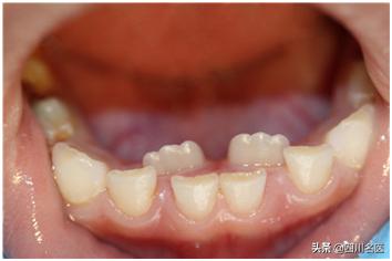 1岁宝宝只长4颗牙而且牙都坏了,小孩1岁半才长出4颗牙齿正常吗