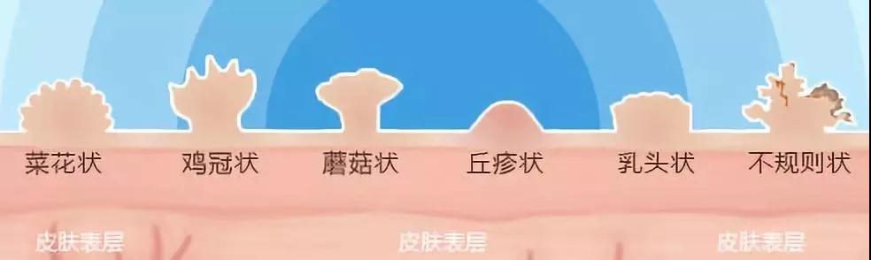 尖锐湿疣能用手抠掉吗？