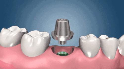 喜迎青岛可恩周年庆，50颗进口种植体免费送！免费送！免费送