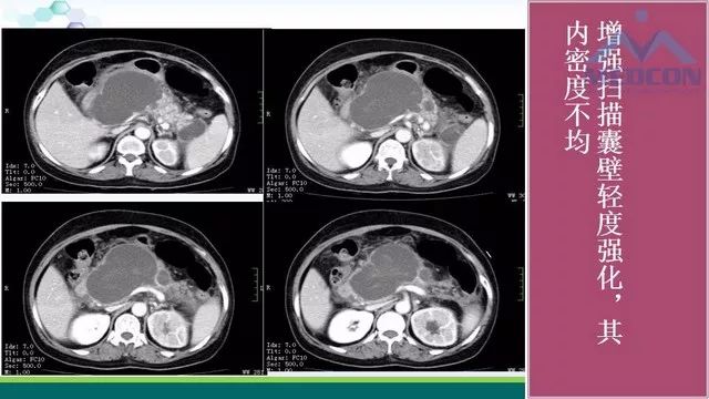 急性胰腺炎的护理措施,急性胰腺炎影像与临床