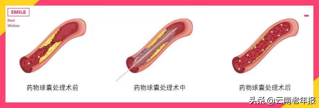 药物球囊支架视频,药物球囊和支架的区别