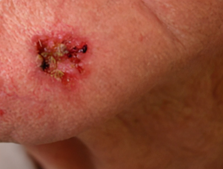 点痣得皮肤癌的几率多大,点痣点出皮肤癌