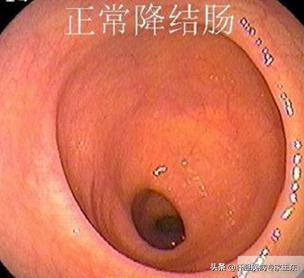 结肠镜检查，痛苦并快乐着