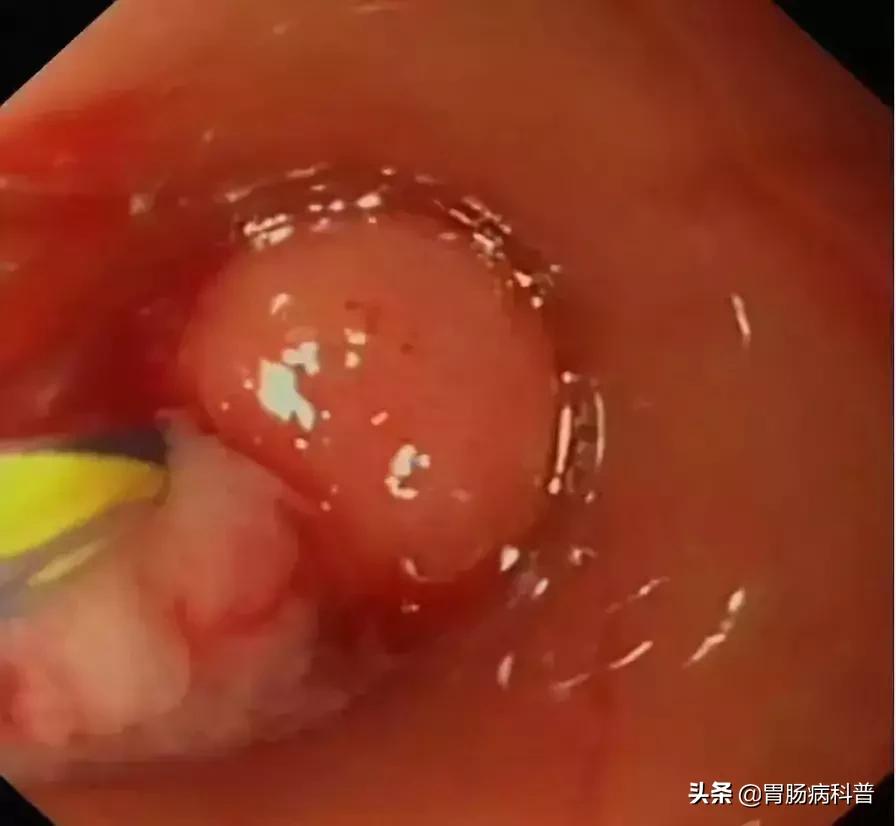 阑尾炎最新内镜微创手术,内镜下阑尾炎治疗术哪里可以做