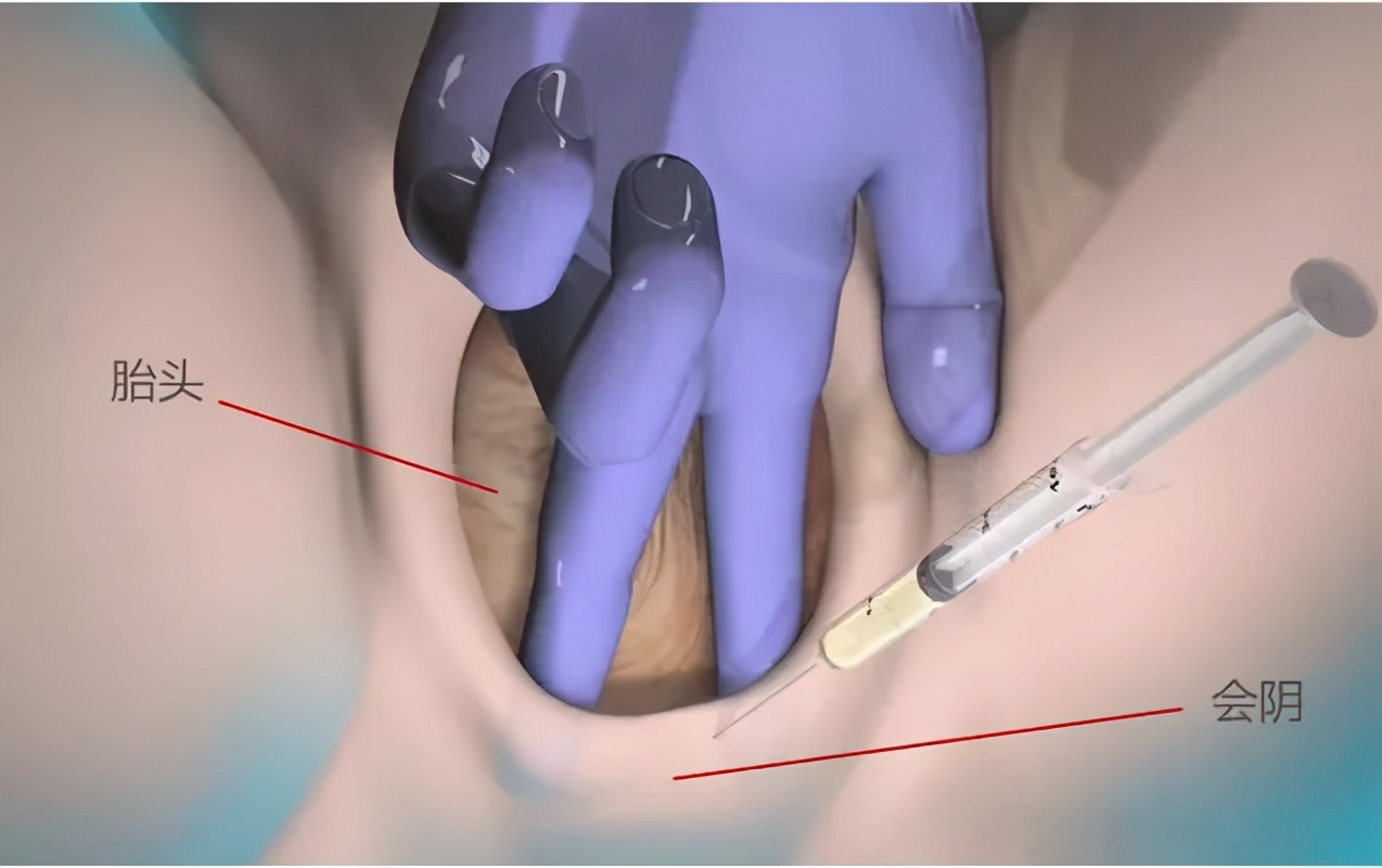 顺产侧切会不会留下后遗症？真相是？
