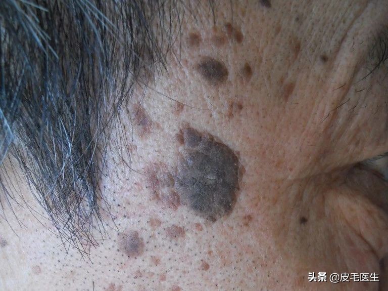 褐斑祛斑最有效方法,年轻人脸上长褐斑老年斑如何治疗