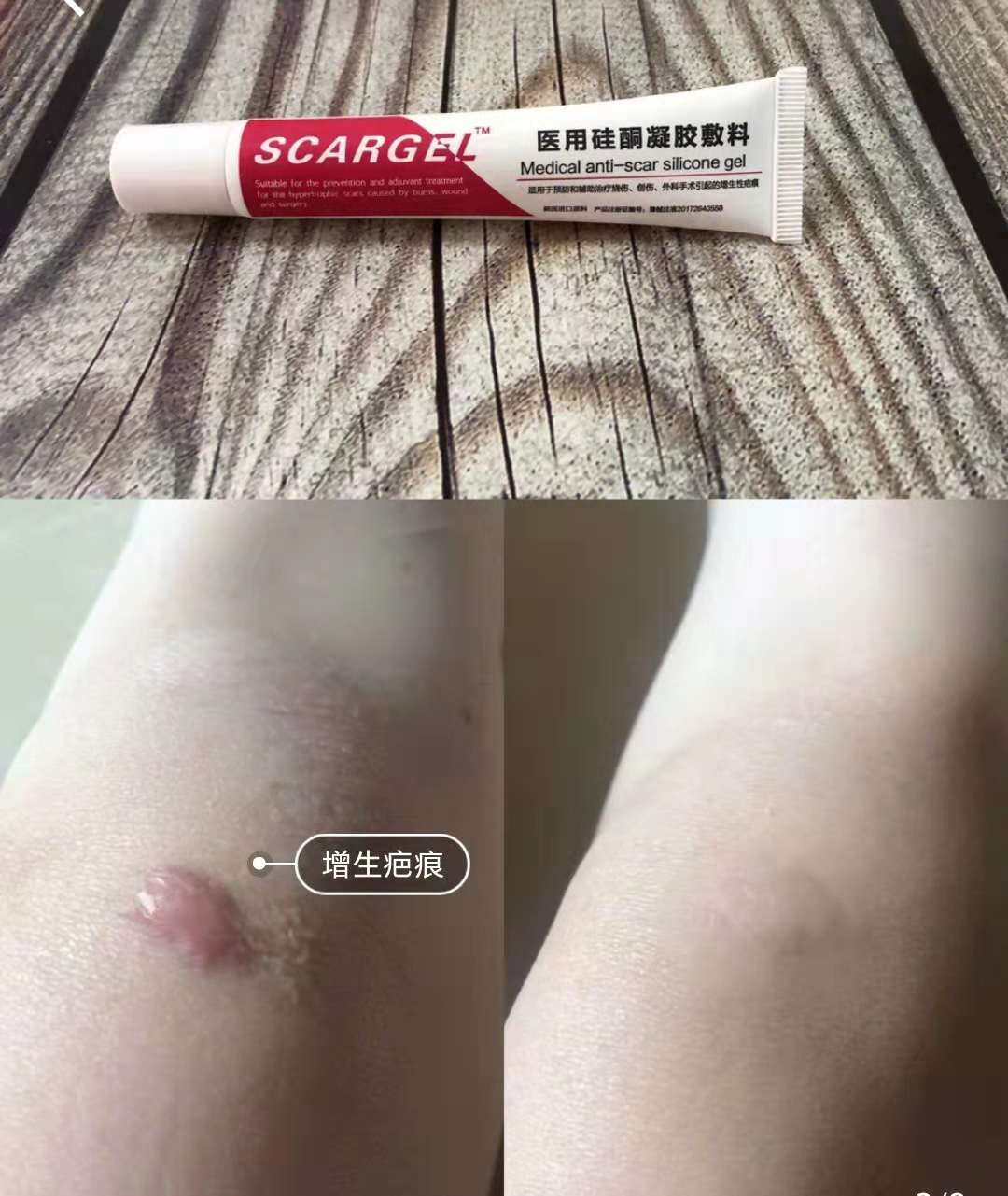 去妊娠纹修复测评推荐,去妊娠纹测评红黑榜