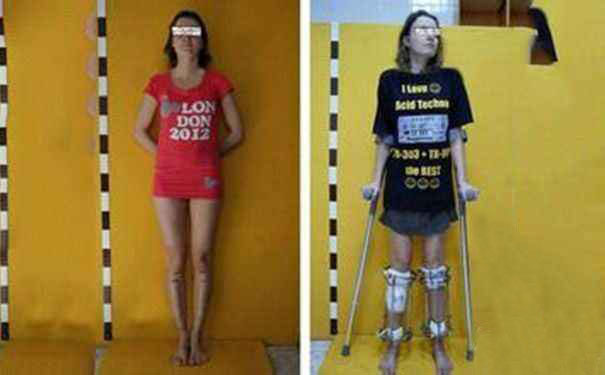 中国有没有断骨增高手术,什么是断骨增高手术