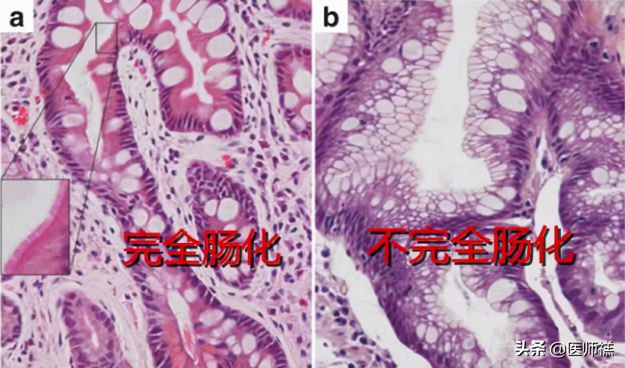 胃炎久治不愈查肿瘤标志物正常,胃炎拖着不治会胃癌吗