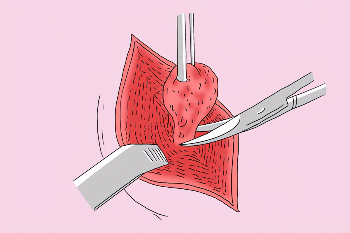 癌细胞死亡会引起癌胚抗原升高吗,癌细胞大量死亡癌胚抗原升高