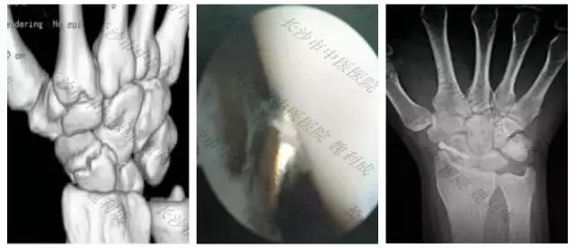 手腕囊肿抽吸出来后可否继续按压,足背囊肿穿刺好还是切除好