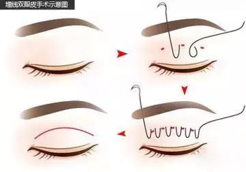 19岁女孩做隆鼻手术8小时内死亡,29岁女生隆鼻死亡真相调查