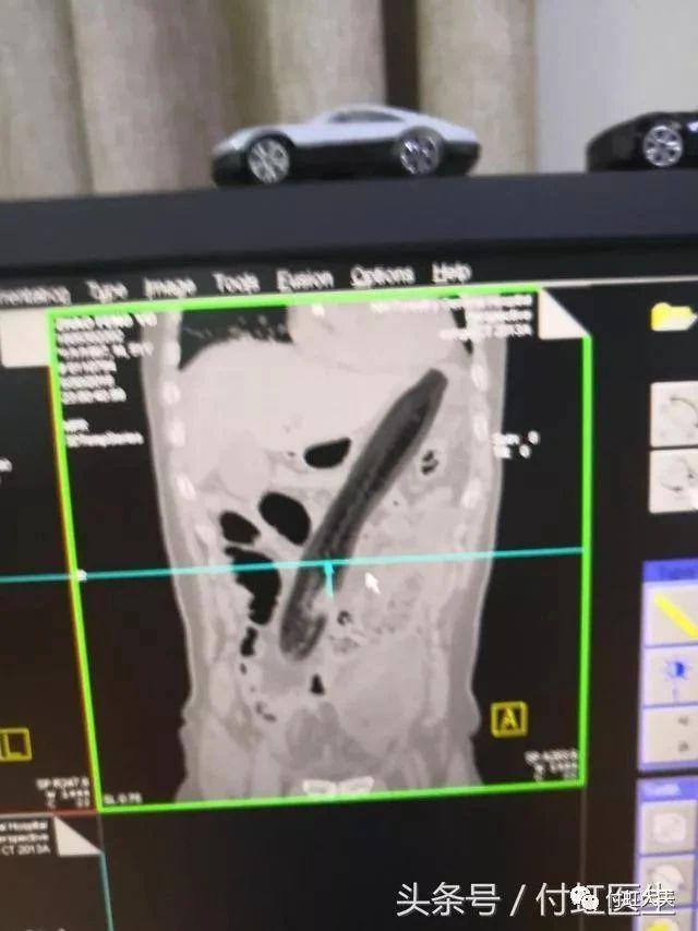 罗非鱼直肠,罗非鱼塞进直肠多长时间