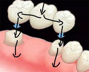 缺一颗上牙在边上镶活牙行吗,单颗牙缺失一个月不补可以吗