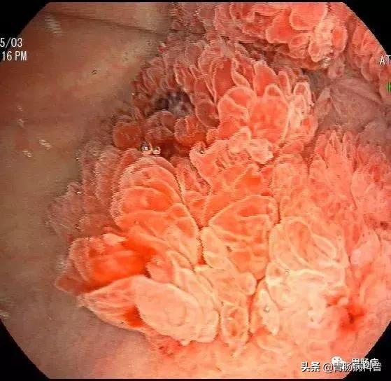 科普胶囊内镜和电子内镜该怎么选,胶囊内镜与无痛胃肠镜区别