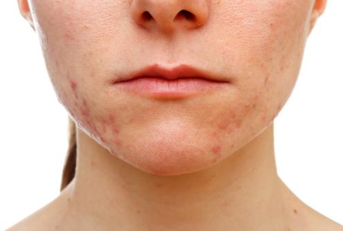 顽固痘痘怎么办教你一招正确祛痘,痘痘破了反复长不停如何正确祛痘