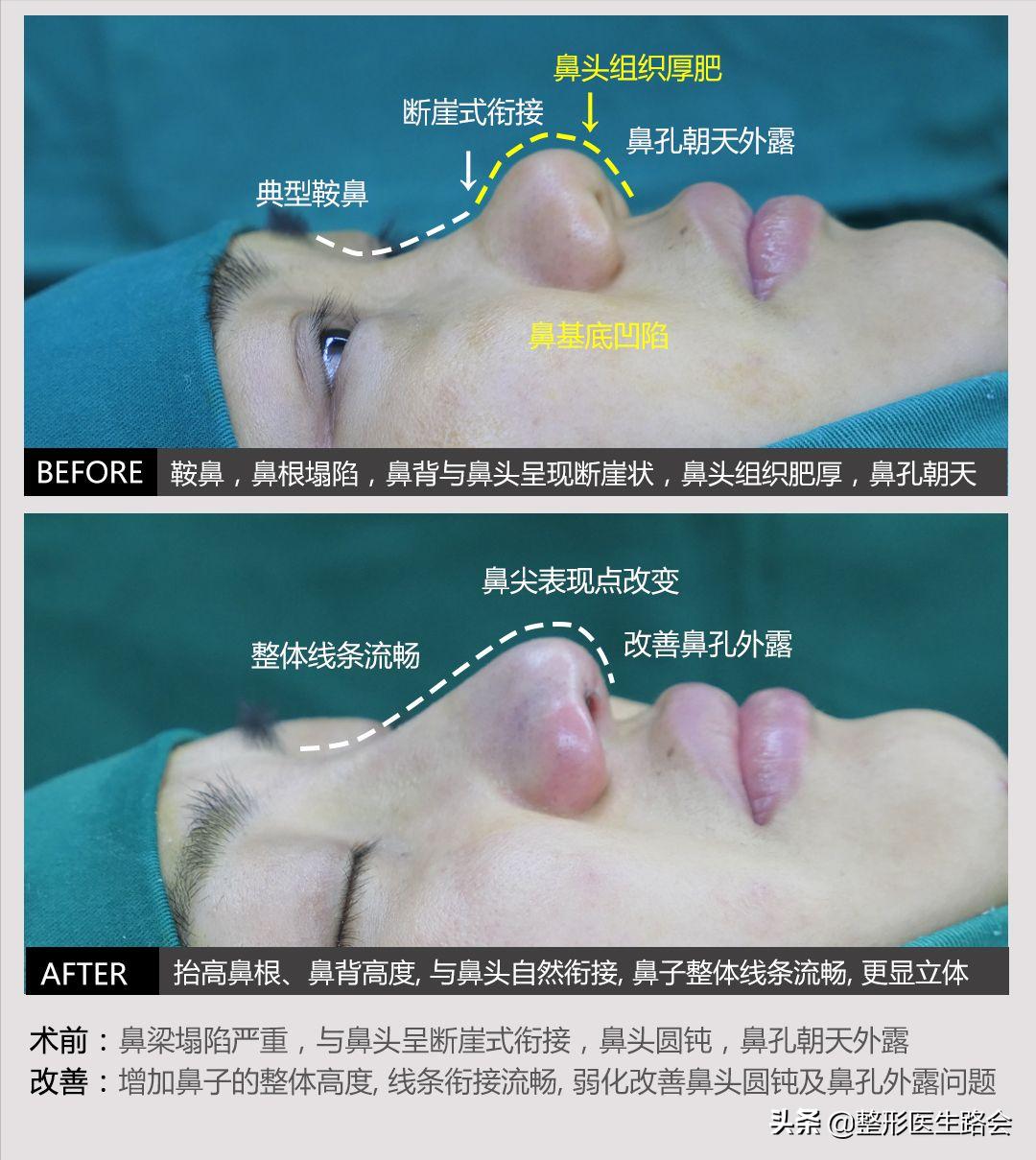 为什么耳软骨只能垫鼻尖不能隆鼻,肋软骨隆鼻时间久了会顶破鼻尖吗