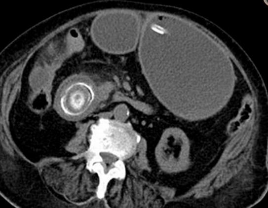 腹部ct能看出来胃的毛病吗,如果胃有问题腹部ct看得出来吗