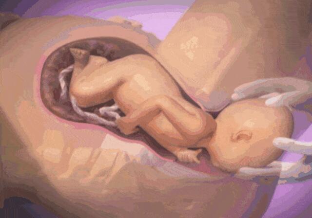 分娩无痛的效果,无痛分娩什么体验