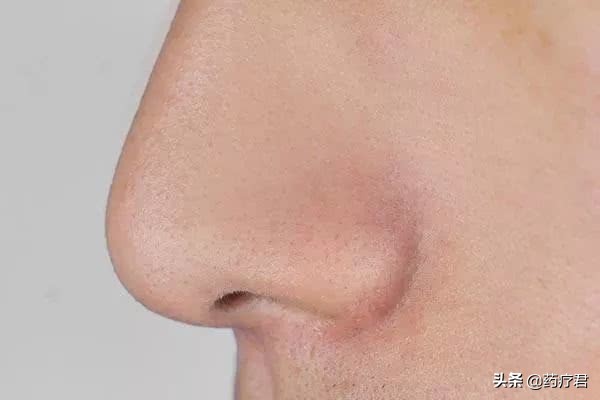 鼻翼两侧挤出白色的东西怎么解决,鼻翼两侧挤出的白色物质怎么治