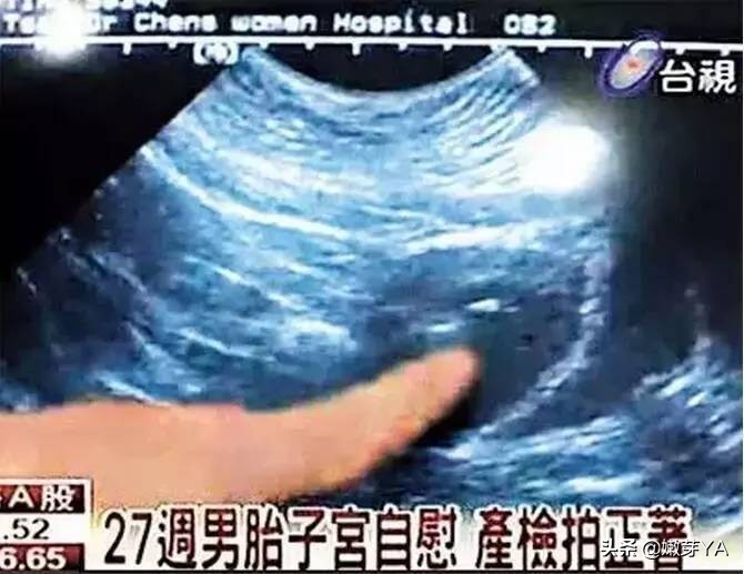 孩子总夹腿？其实没你想的那么可怕