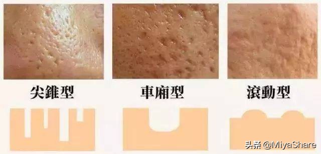 毛孔收敛水真的能收毛孔吗,毛孔收敛水的正确步骤是什么