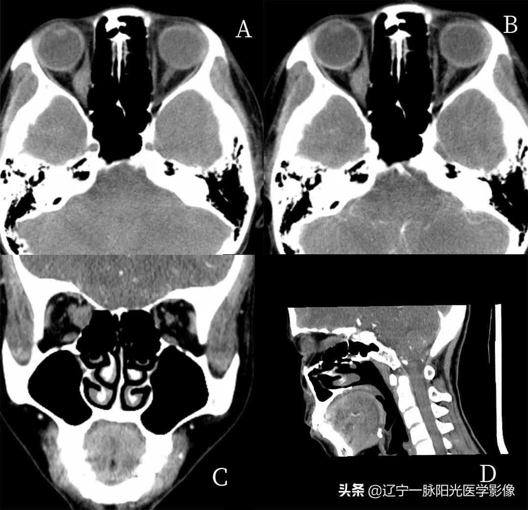 眼部肿瘤治疗有哪些,眼部肿瘤症状有哪些