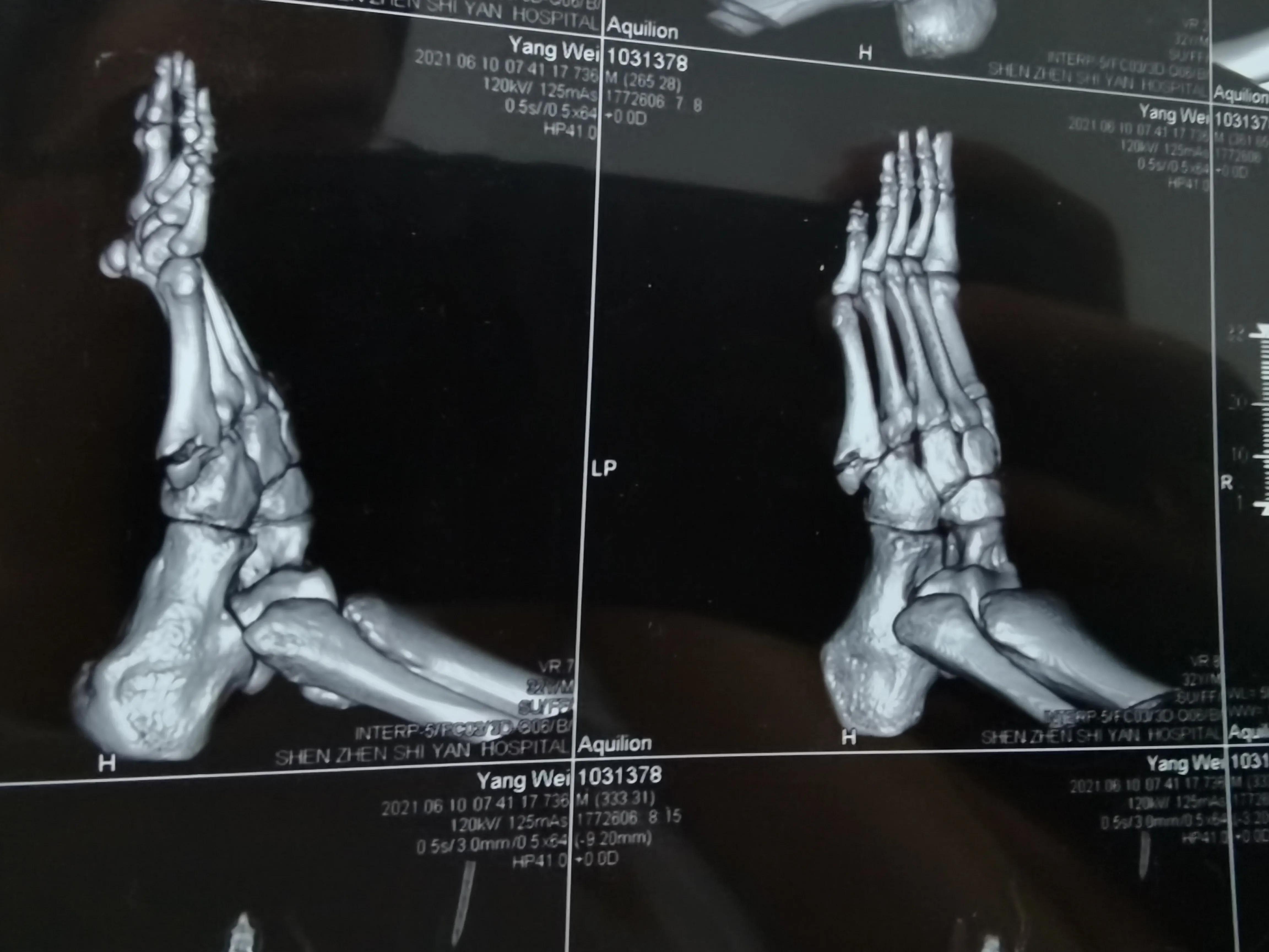 第五跖骨粉碎性骨折多久后能走路,第五跖骨基底骨折100天了走路肿