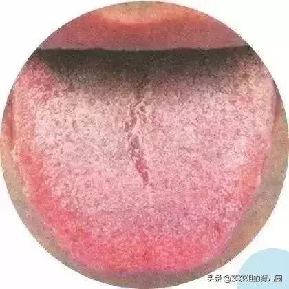 舌头白苔有裂纹还有红点怎么调理,舌头有红点有裂纹是怎么回事