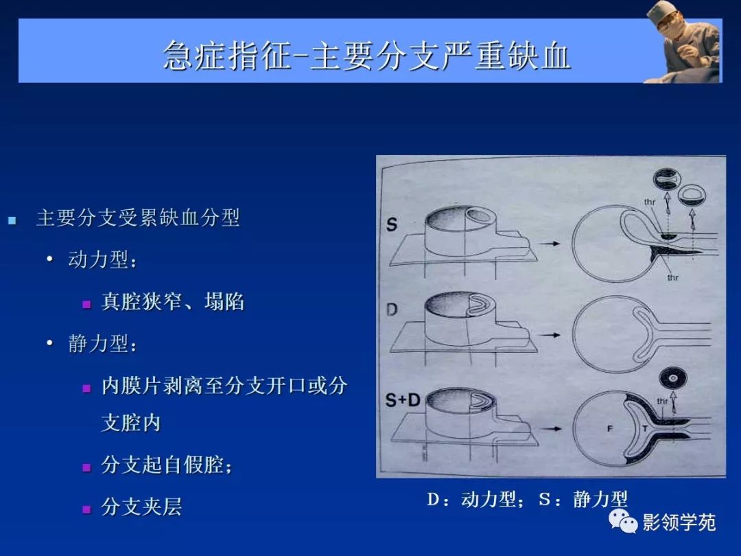 主动脉夹层壁间血肿如何鉴别,主动脉夹层血肿溃疡