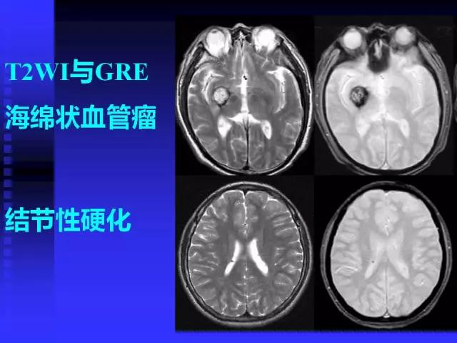 头颅mri读片视频教程,颅脑mri读片入门教程视频讲解全集