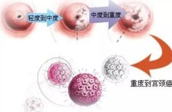 6种最常见癌症的早期症状,六种常见的癌有哪些