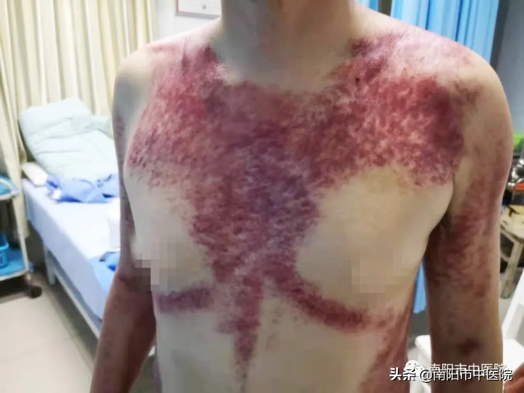 南阳市中医院开展多种中医特点治疗项目——虎符铜砭刮痧