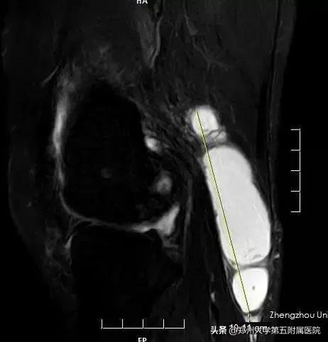腘窝囊肿用针灸和蜡疗能治好吗,腘窝囊肿手术切口如何选择