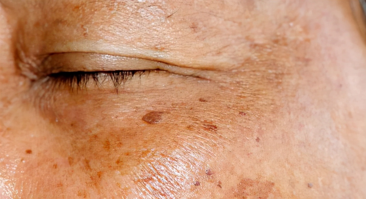 老年人长骨刺手术,70岁老人骨刺手术好吗