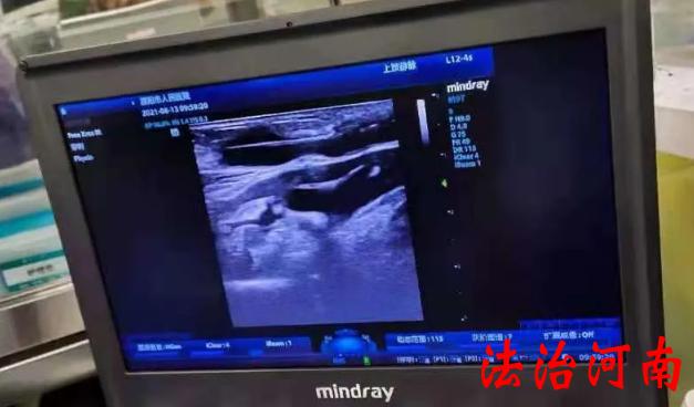 濮阳市人民医院血液净化室成功完成两例彩超引导下动静脉内瘘球囊扩张术